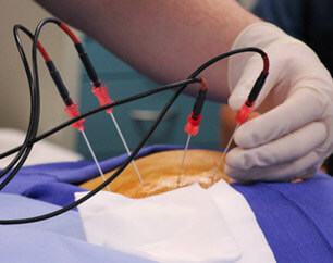 radio frequency ablation